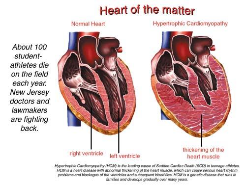 Cardiac Hypertrophy Athlete s Heart